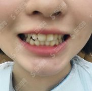 华西口腔医院韩向龙正畸怎么样？所做正畸案例及价格参考