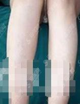 北京长虹激光脱毛价目表2021,激光脱毛后拥有了自信,完成了多年夙愿!