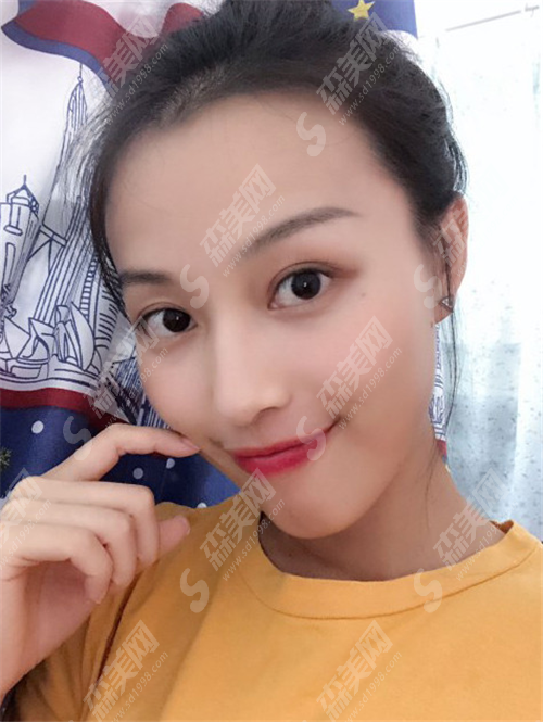 泰安韩美整形靠谱吗?隆鼻手术过程及术后果分享