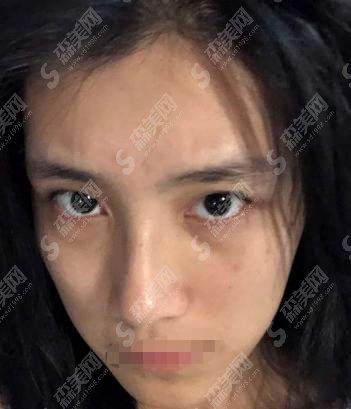 深圳大学总医院整形美容科好的医生介绍，案例反馈口碑鲜明，2021双眼皮价格
