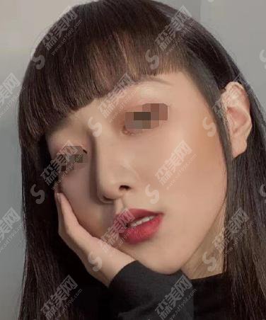 117医院整形科做的隆鼻手术术后恢复过程如何?附隆鼻案例