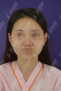 117医院整形科做的隆鼻手术术后恢复过程如何?附隆鼻案例