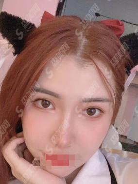 沈阳杏林征信医院的实力突飞猛进!做的双眼皮果较好!