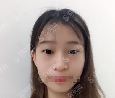 上海九院真的能做双眼皮么？还是宣传作假？让我们来揭秘！