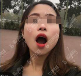 美莱韩旭医生做的牙齿矫正真的好？附牙齿矫正真人实例！