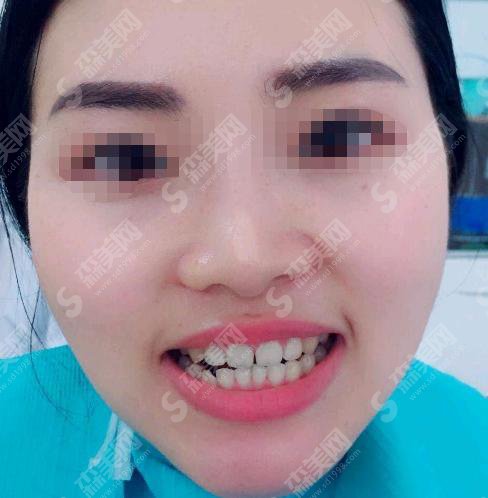 成都极光口腔院价格是多少？附牙齿矫正价格收费参考！