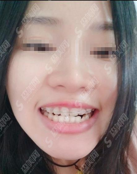 成都极光口腔院价格是多少？附牙齿矫正价格收费参考！