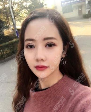 天津市眼科医院整形外科价目表2021，含盖眼部整形案例