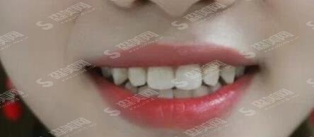 广医二院牙科价目(价格)表,2021详情曝光及案例