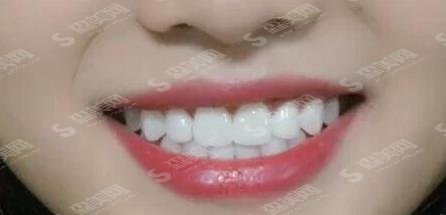 广医二院牙科价目(价格)表,2021详情曝光及案例