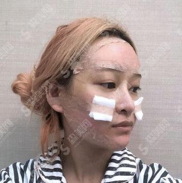 内蒙古医科大学附属人民医院整形外科,2021年度整形价格分享及脂肪填充案例