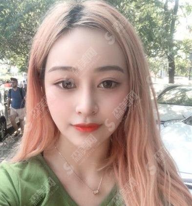 内蒙古医科大学附属人民医院整形外科,2021年度整形价格分享及脂肪填充案例