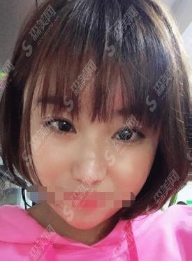 北京黄寺医院做的双眼皮果反馈较好,内含医院介绍及价格明细分享