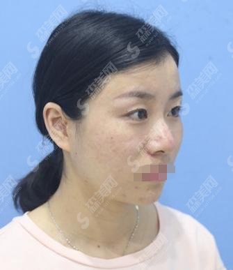 北京黄寺医院做的双眼皮果反馈较好,内含医院介绍及价格明细分享