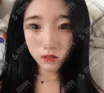 九院拉皮果术后反馈技术一绝,案例分享及较新费用表明细