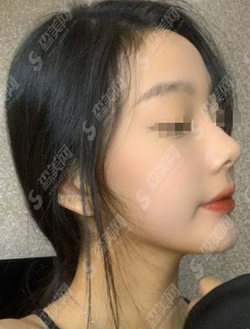 九院拉皮果术后反馈技术一绝,案例分享及较新费用表明细