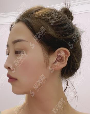郑大二附院整形科实力如何？价格惠民嘛？隆鼻技术果自然吗？