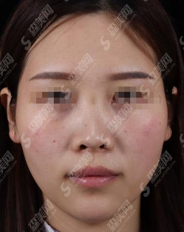 郑大二附院整形科实力如何？价格惠民嘛？隆鼻技术果自然吗？