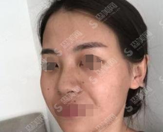 武汉协和整形美容医院好评不断，鼻子案例实时分享，医生技术好！
