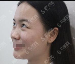 嘉和整形医院整形医生技术惊人!附隆鼻案例和隆鼻费用