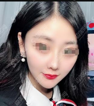 菏泽华美整形医院靠谱吗？医生专业吗？附隆鼻案例和隆鼻价格表出炉
