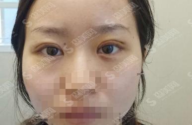 上海千美整形医院做双眼皮的医生哪个好？附坐诊医生和费用参考