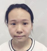 连云港市第二人民医院整形科价目表公布，含硅胶假体隆鼻恢复详情及图片欣赏