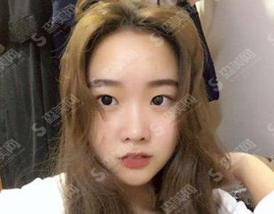 德州市立医院整形美容科发展如何?医院简介及眼部手术案例分享