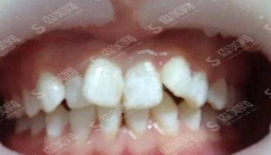 义乌市中心医院口腔科价目表，牙科相关正畸案例&术后案例反馈