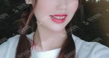 义乌市中心医院口腔科价目表，牙科相关正畸案例&术后案例反馈