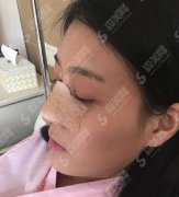 榆林市第二医院整形美容外科隆鼻做的如何？小仙女鼻部手术案例术后反馈