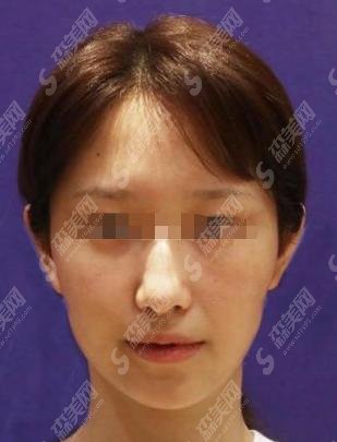 浙二医院整形科做的光子嫩肤果如何？内含整形案例对比照+医生介绍