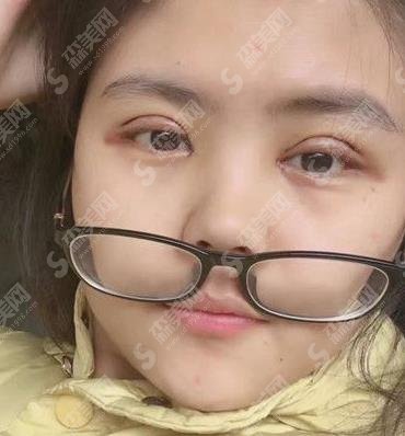 郑州美丽之星医疗整形做双眼皮怎么样？案例分享及价格公布