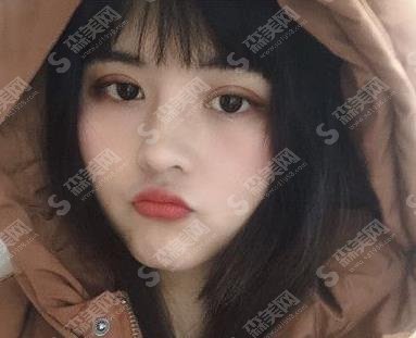 郑州美丽之星医疗整形做双眼皮怎么样？案例分享及价格公布