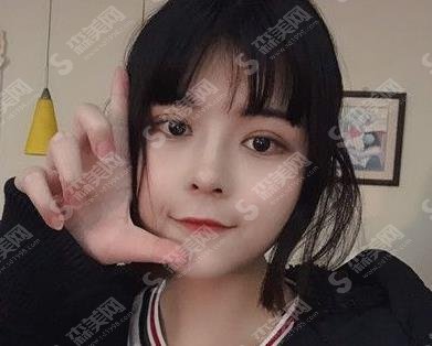 郑州美丽之星医疗整形做双眼皮怎么样？案例分享及价格公布