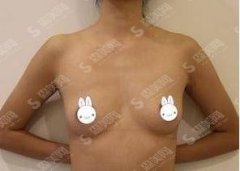 济宁医学院附属医院整形科价目表2021，假体隆胸后让我做了真正女人！