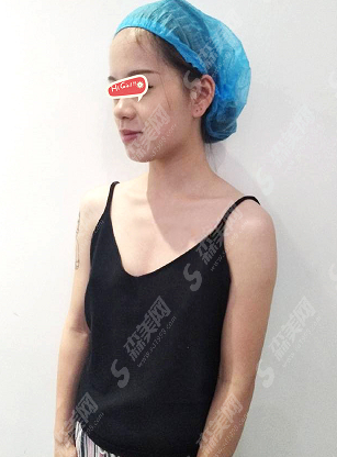 沈阳美莱医院正规不?沈阳美莱整形的实力怎么样？附带假体隆胸的案例果展示