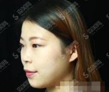 杭州市第一人民医院整形科价格表查询，肋软骨隆鼻案例及恢复详情