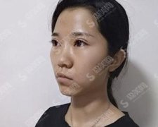 山东省立医院整形外科隆鼻技术可以吗？附鼻部手术案例＋价格表出炉！