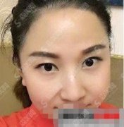 无锡人民医院美容科价格，通过项目让我实现了小脸之梦