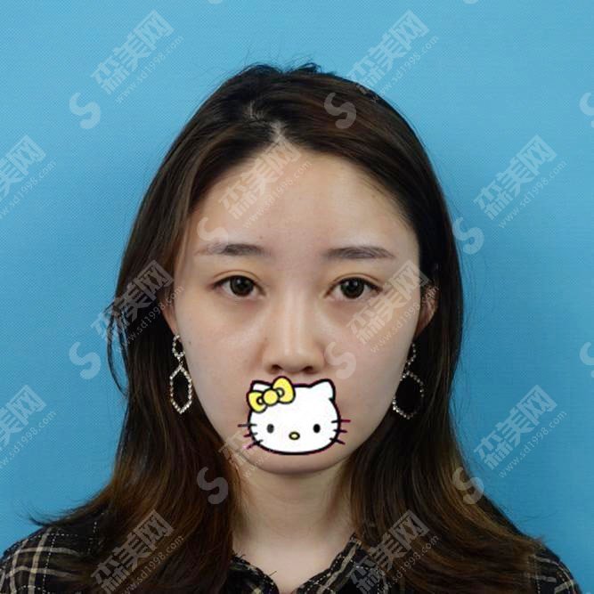 修志夫隆鼻价格标准是怎样的?隆鼻的康复过程图多方面公布,医生实力和价位在线查询!