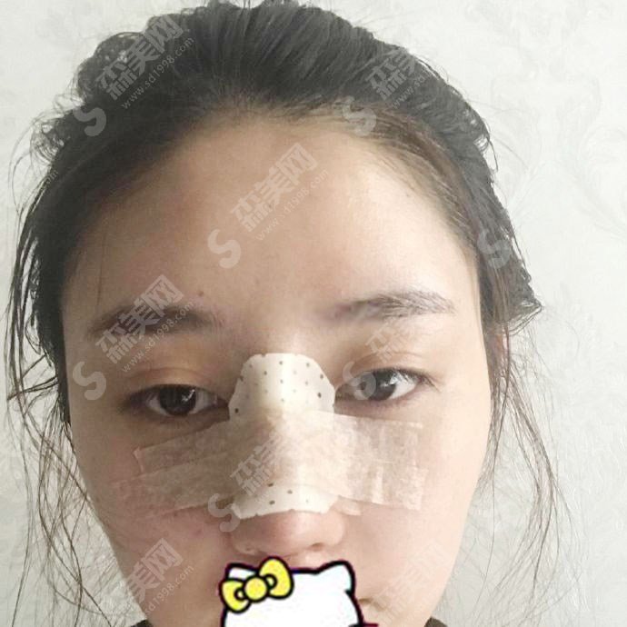 修志夫隆鼻价格标准是怎样的?隆鼻的康复过程图多方面公布,医生实力和价位在线查询!