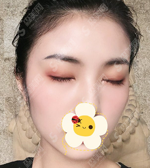 徐州四院周同葵双眼皮手术的果怎样?徐州四院周同葵医生的技术实力分析,整形价格公布!