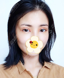 徐州四院周同葵双眼皮手术的果怎样?徐州四院周同葵医生的技术实力分析,整形价格公布!