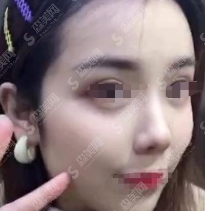 茂名市人民医院整形外科怎么样?鼻子果简直好的不得了！