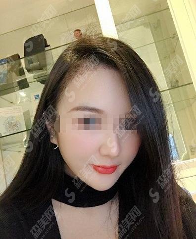 成都恒美植发果如何呢？追美者反馈果案例实享！