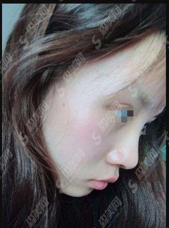 昆明美伊莱整形医院隆鼻贵么?果好吗?坐诊医生介绍1