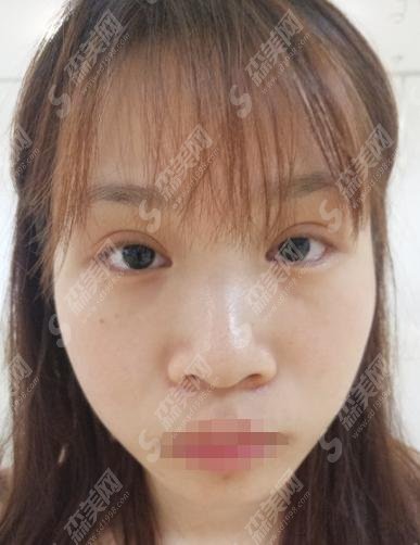 昆明美伊莱整形医院隆鼻贵么?果好吗?坐诊医生介绍1