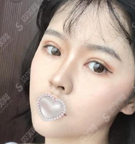 南京柏盛柏微整形医院胡志奇医生整形水平如何？附医生手术案例分享