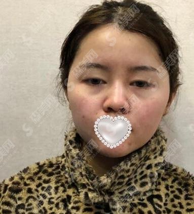 南京柏盛柏微整形医院胡志奇医生整形水平如何？附医生手术案例分享